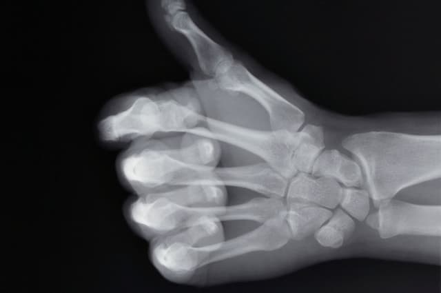 X-ray of hand making thumbs up gesture
